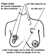 efter brst- och portoperation